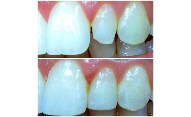 Tooth coloured fillings